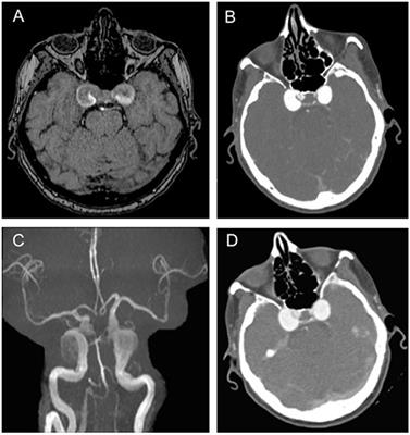 Bilateral Cavernous Carotid Aneurysms: Atypical Presentation of a Rare Cause of Mass Effect. A Case Report and a Review of the Literature